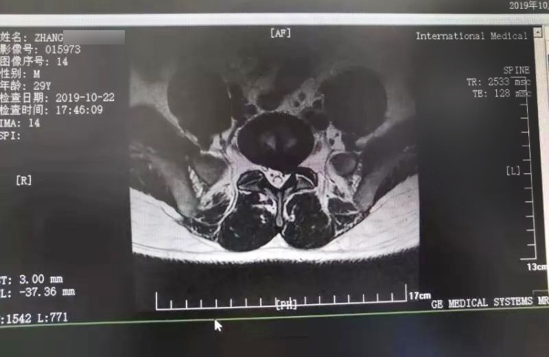 三秦網(wǎng)報道—西安國際醫(yī)學中心骨科醫(yī)院成功完成首例椎間孔鏡手術