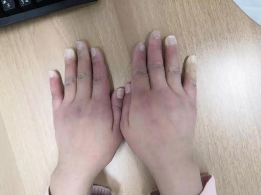 “手指、腳趾發(fā)白、發(fā)紫……”這些“小毛病”千萬(wàn)別大意