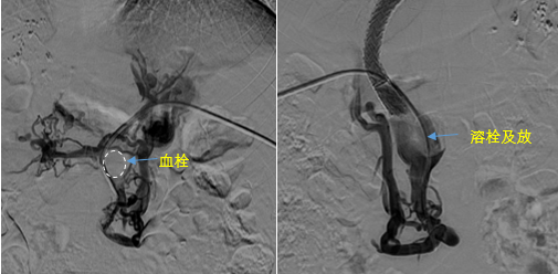 血栓攔路，如何破局——罕見(jiàn)巨大門靜脈血栓TIPS手術(shù)實(shí)錄