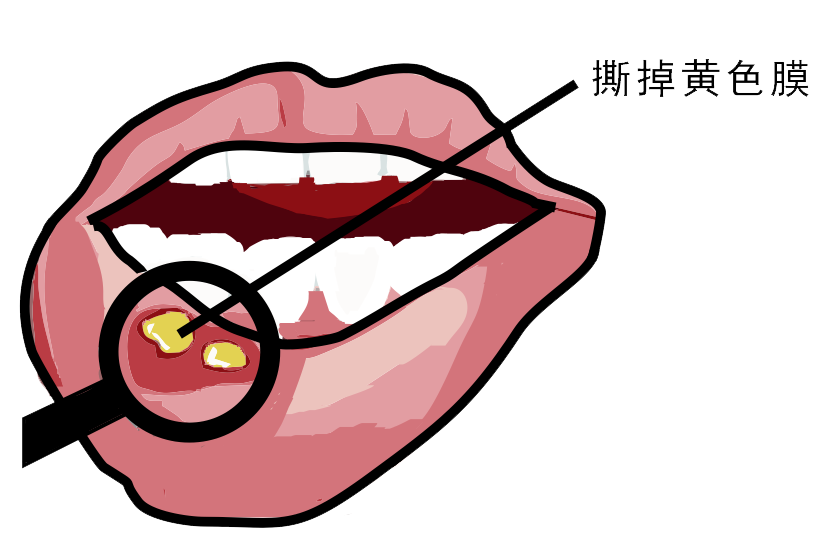 經(jīng)?？谇粷儯娴闹皇侨本S生素嗎？