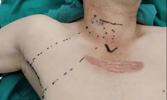 術(shù)后傷口可以“隱身”嗎？