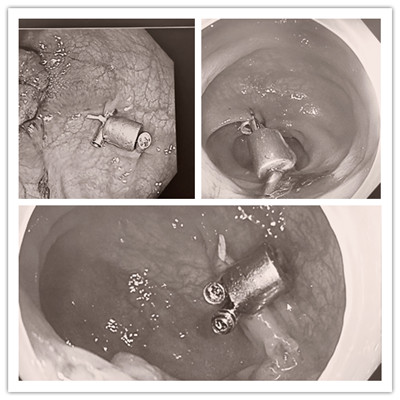 消化病醫(yī)院內(nèi)外科聯(lián)合開展3例“磁環(huán)預標記輔助腹腔鏡結(jié)、直腸癌根治術”