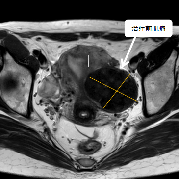 保子宮、保留生育功能—磁波刀治療子宮肌瘤