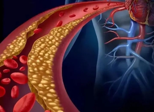 警惕！冠脈支架術(shù)后這些誤區(qū)千萬別踩，趕緊收藏！