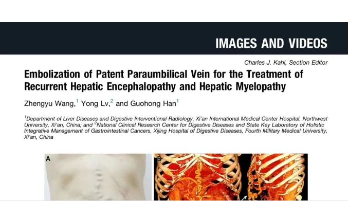 我院護(hù)理團(tuán)隊(duì)臨床成果登榜國際肝病權(quán)威期刊，影響因子11.6